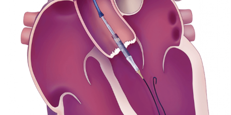 aortaklep
